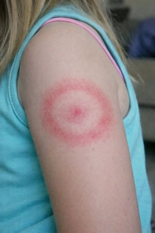 A Red Ring on Your Child’s Skin: What It Might Mean and When to Seek Advice