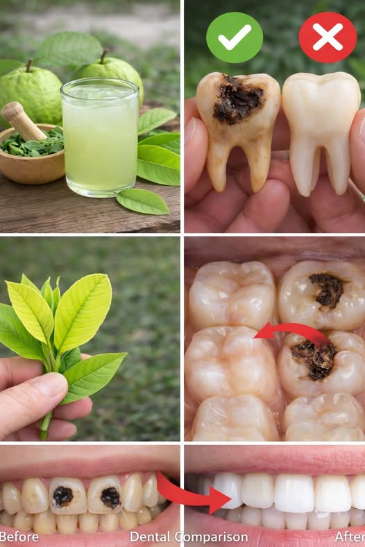 Oral hygiene plays a crucial role in overall health. While brushing and flossing remain the foundation of dental care, many people are also exploring natural ingredients that may support healthier gums and fresher breath. One plant that has gained attention in both traditional medicine and modern research is guava leaves (Psidium guajava).